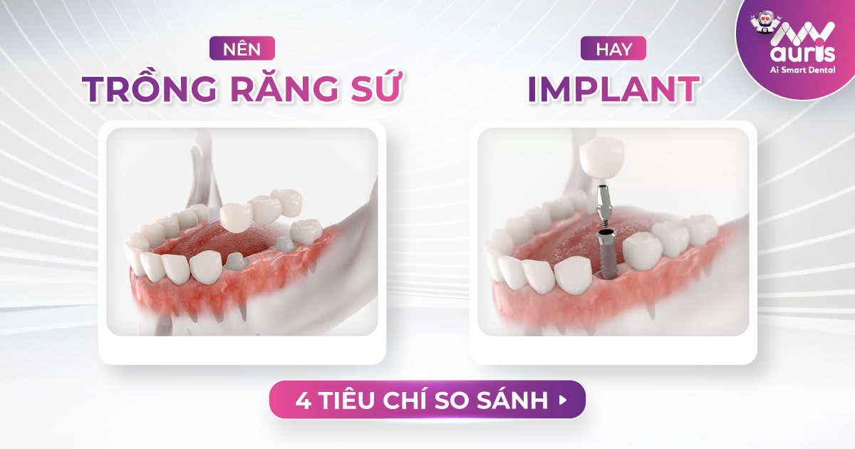 nên trồng răng sứ hay implant