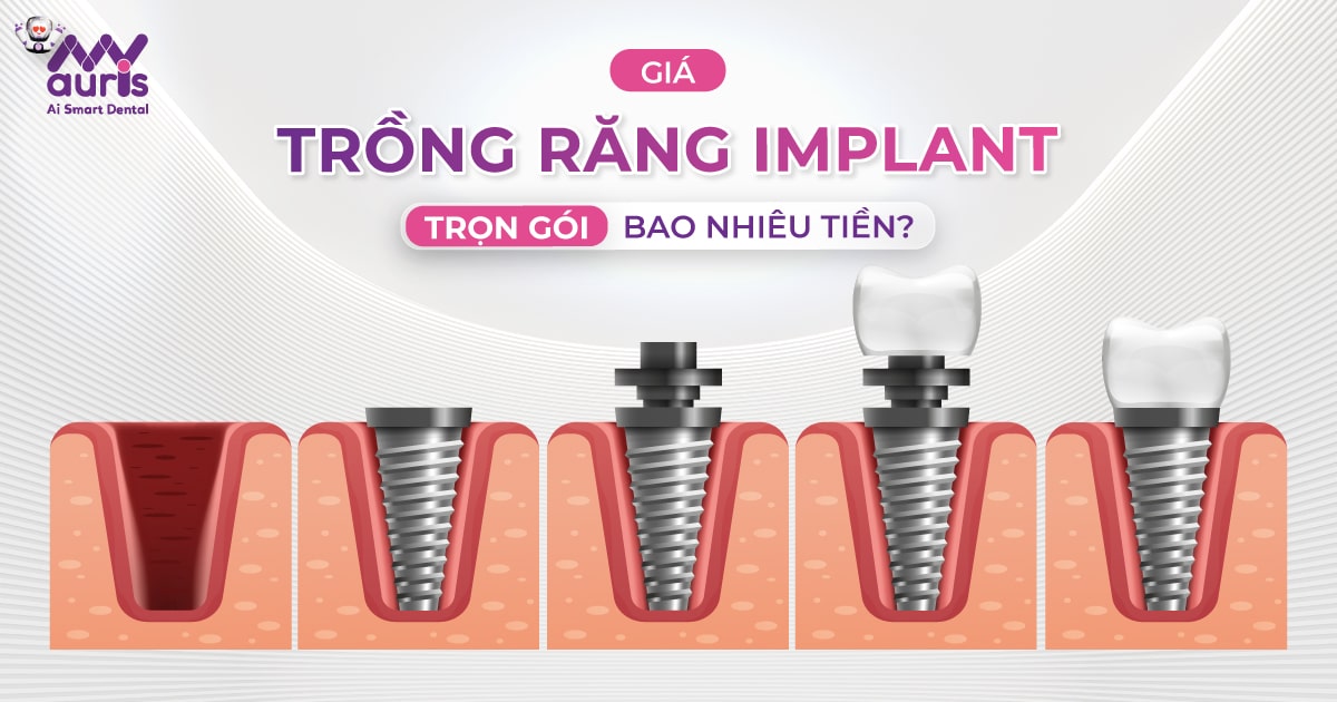 giá tiền trồng răng implant