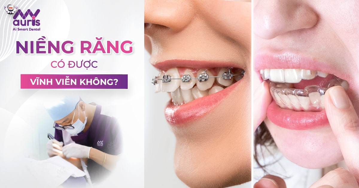 niềng răng có được vĩnh viễn không