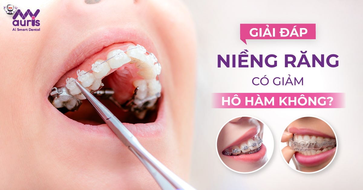 niềng răng có giảm hô hàm không