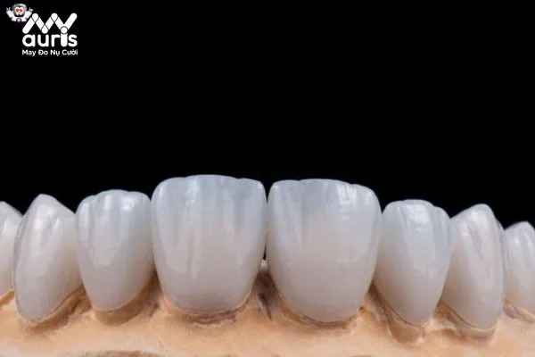 Cách nhận biết răng sứ Cercon theo từng loại 