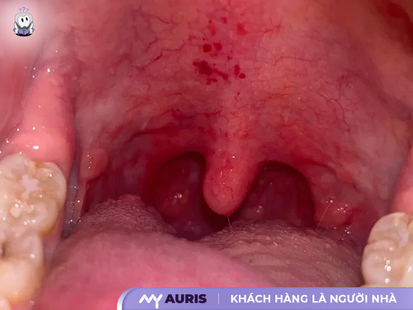 Cách Trị Nuốt Nước Bọt Đau Họng