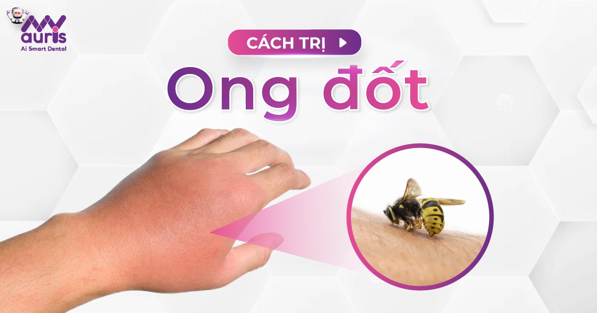 5 cách trị ong đốt bị sưng ngứa hiệu quả