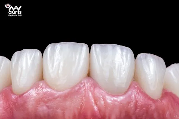 Răng sứ cercon là răng sứ thế nào?