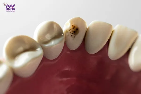 Trường hợp phù hợp phục hình răng sứ cercon - Răng sâu 