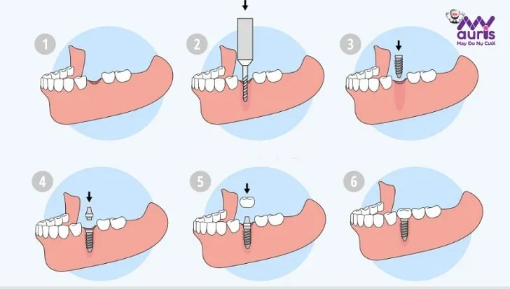 dịch vụ trồng răng implant