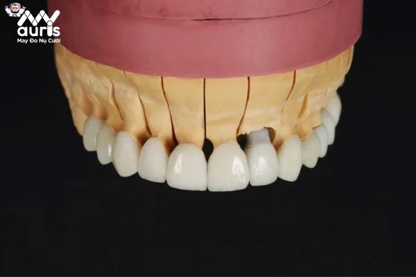 Độ bền của răng sứ Cercon trong bao lâu?