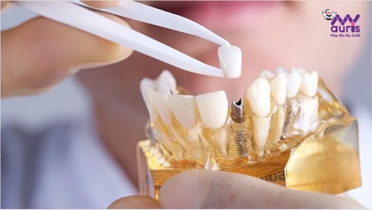 giá tiền trồng răng implant
