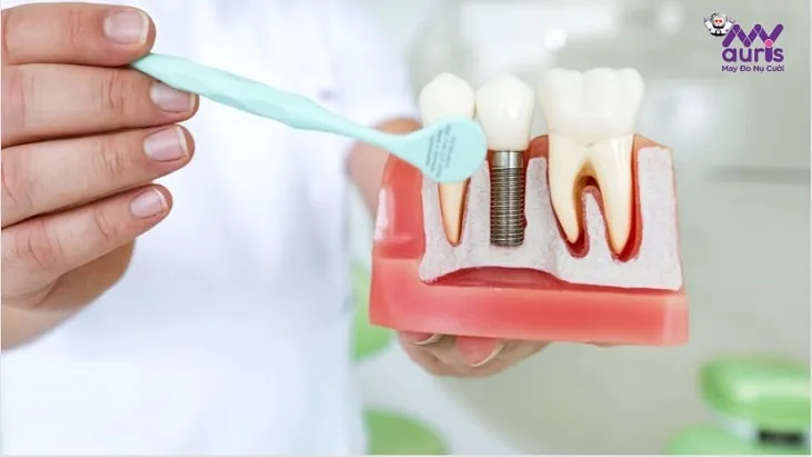 giá trồng răng implant hàn quốc