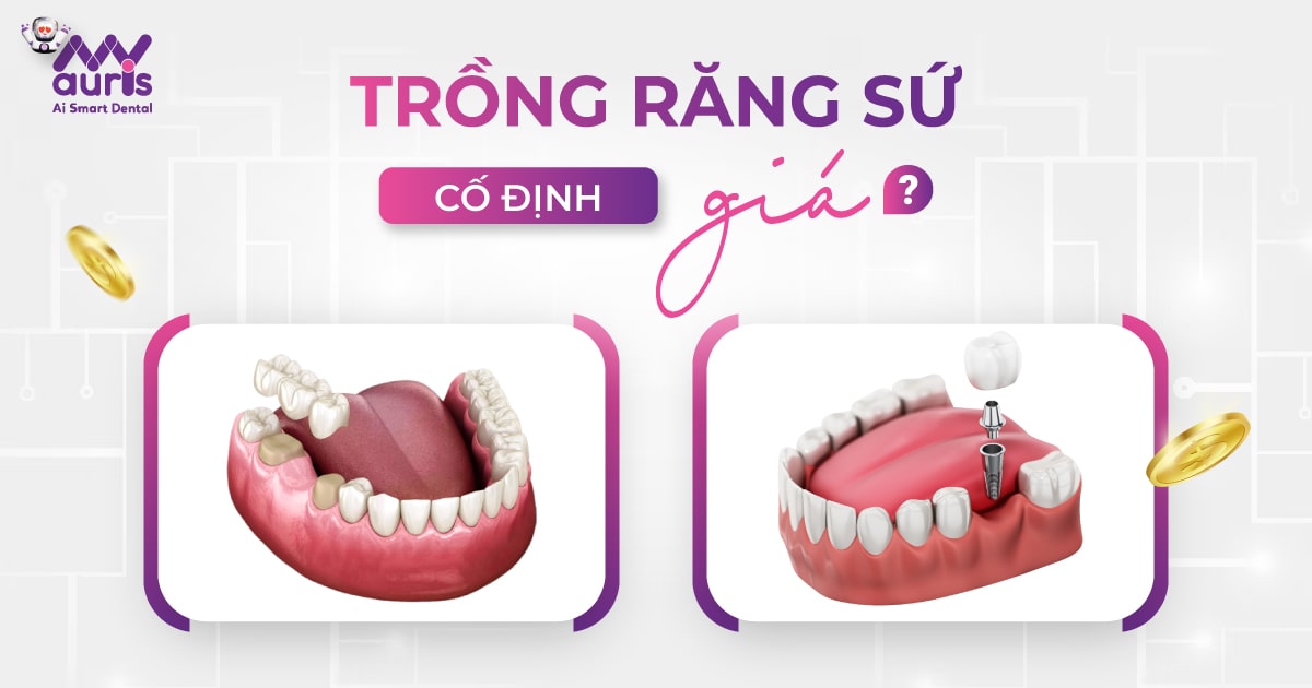 Giá trồng răng sứ cố định cho 2 phương pháp chính