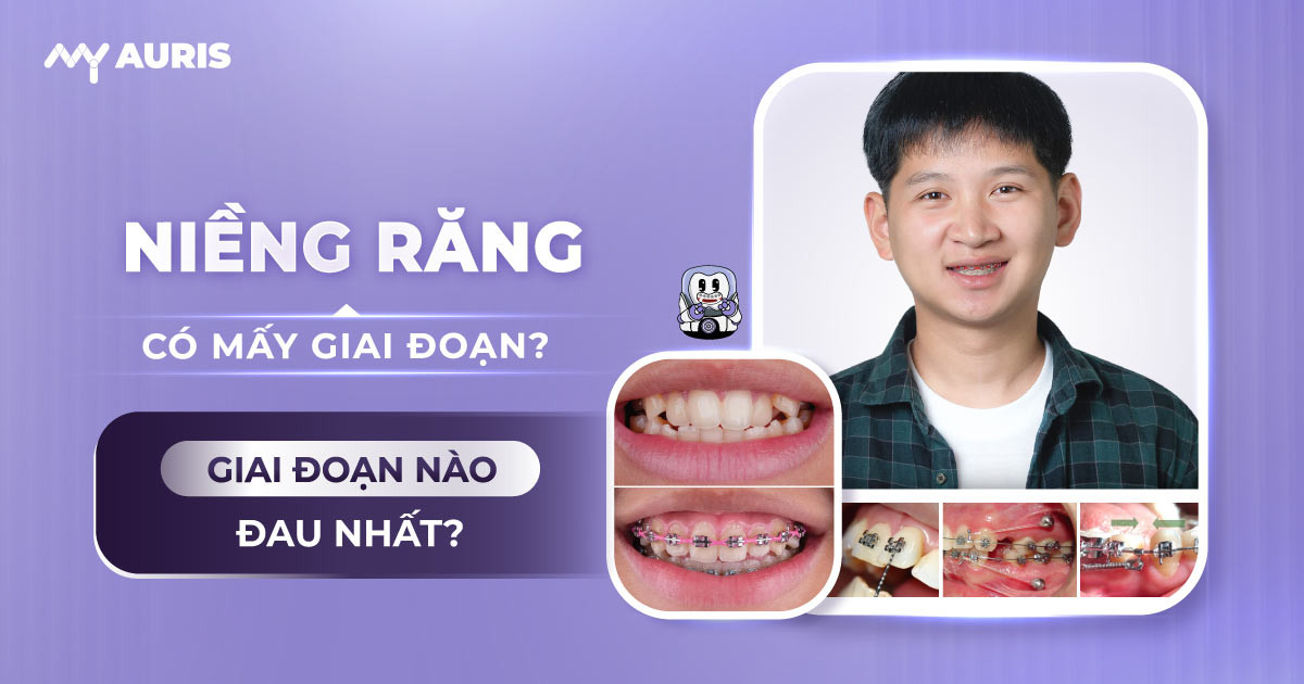 giai đoạn niềng răng