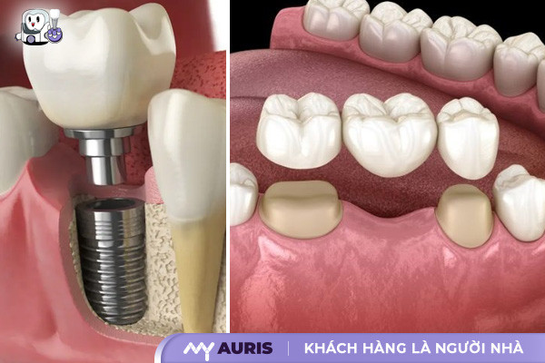 cấy răng sứ,so sánh cấy răng implant và cầu răng sứ