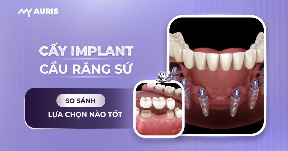 cấy răng sứ,so sánh cấy răng implant và cầu răng sứ