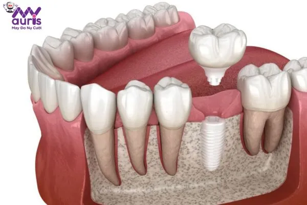 Làm răng sứ Implant là kỹ thuật gì?