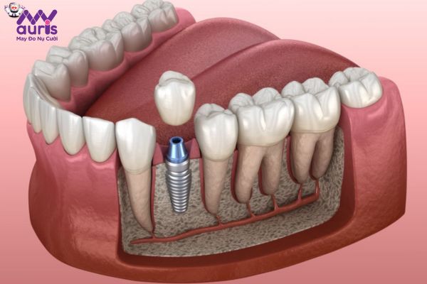 Quy trình bọc răng sứ trên Implant thực hiện như thế nào?