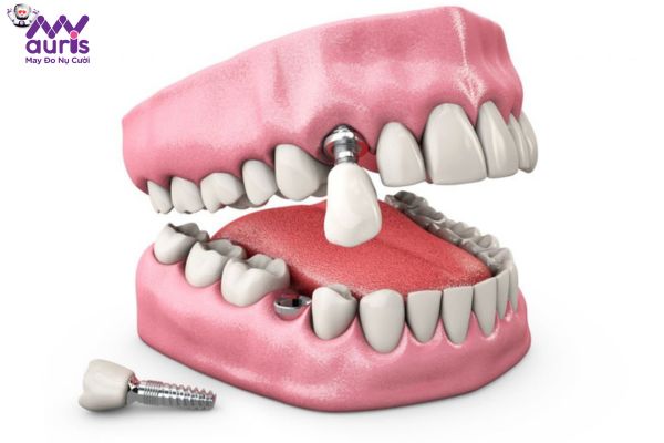 Xuất hiện tràn lan quảng cáo trồng Implant giá rẻ - Loạn giá trồng răng Implant 