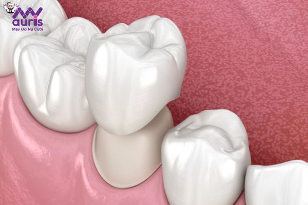 Những trường hợp nào cần mài răng trồng răng sứ?