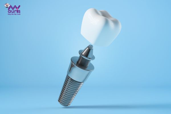 Tiêu chí lựa chọn nên trồng răng implant loại nào?