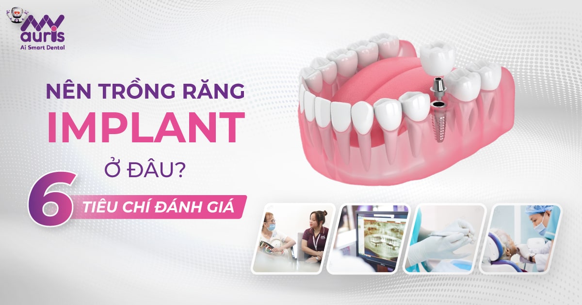 Nên trồng răng implant ở đâu