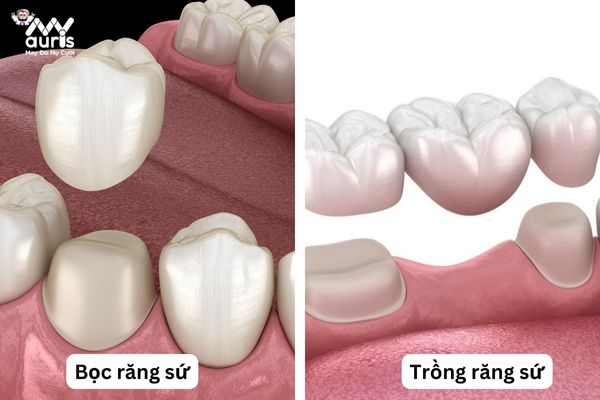 Kỹ thuật thực hiện - Sự khác biệt giữa trồng răng sứ và bọc răng sứ