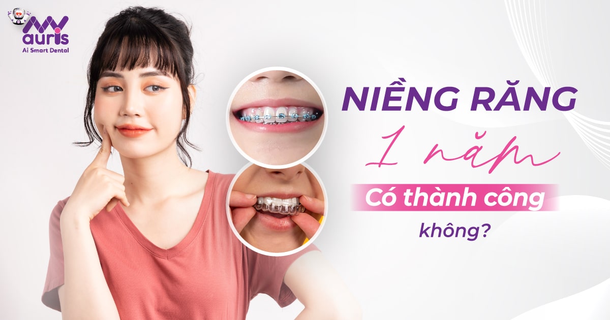 Niềng răng 1 năm có thành công không?