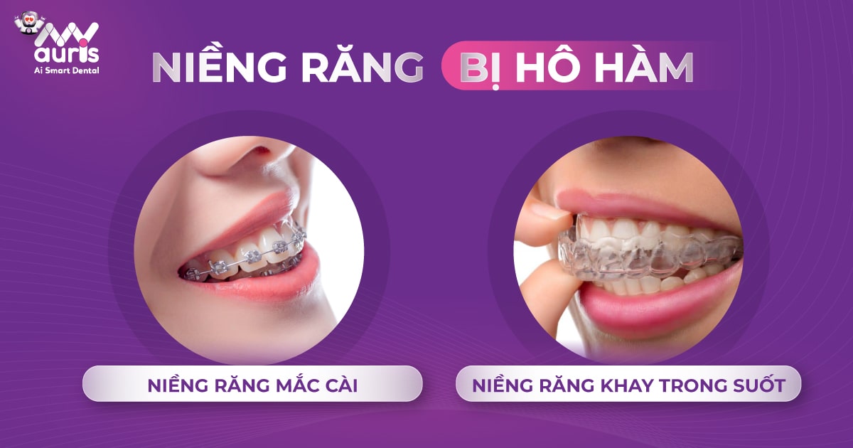 Niềng răng bị hô hàm được không? (Từ 2 kỹ thuật chính)