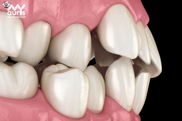 Niềng răng bị lệch khớp cắn liệu có mang lại hiệu quả không?