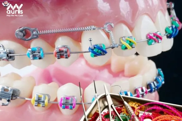 Cung hàm răng quá cứng sẽ cần bắt vít khi niềng