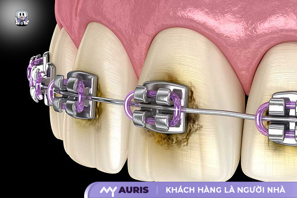 Niềng răng có cạo vôi răng được không