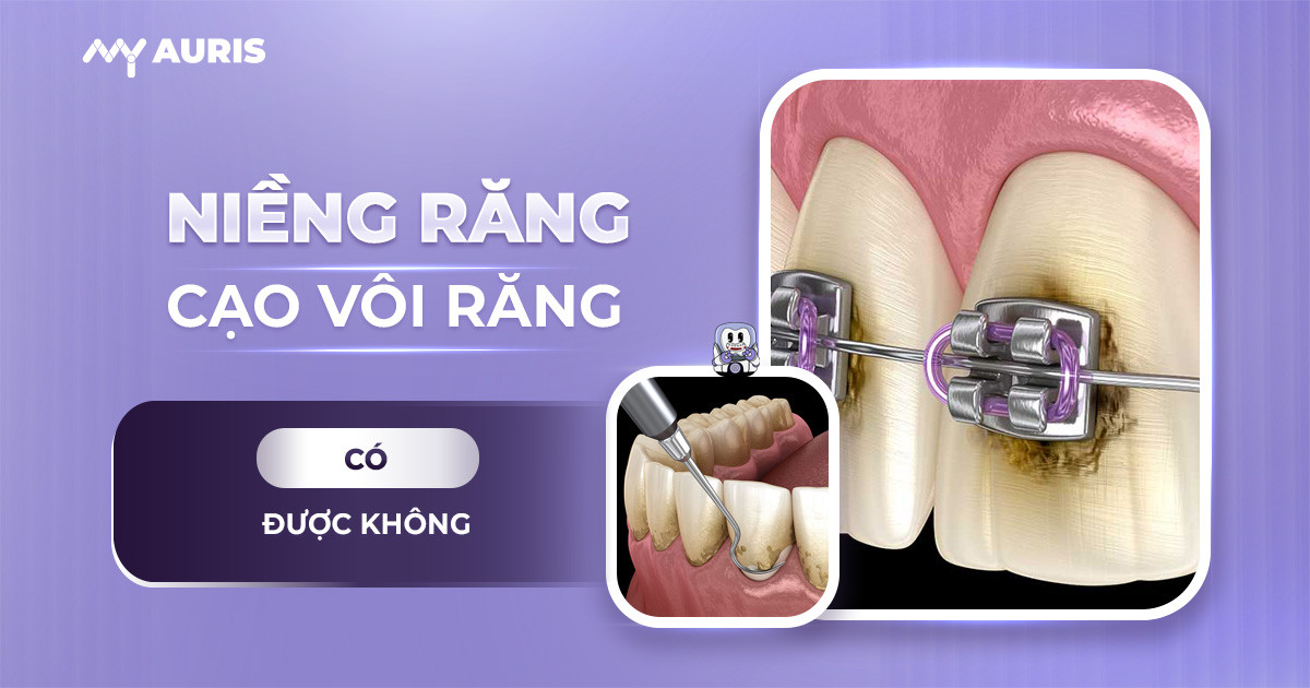 Niềng răng có cạo vôi răng được không