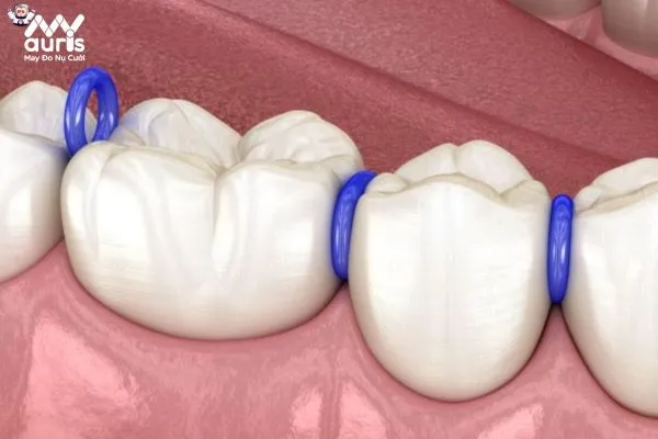Các giai đoạn trong chỉnh nha niềng răng cần chú ý