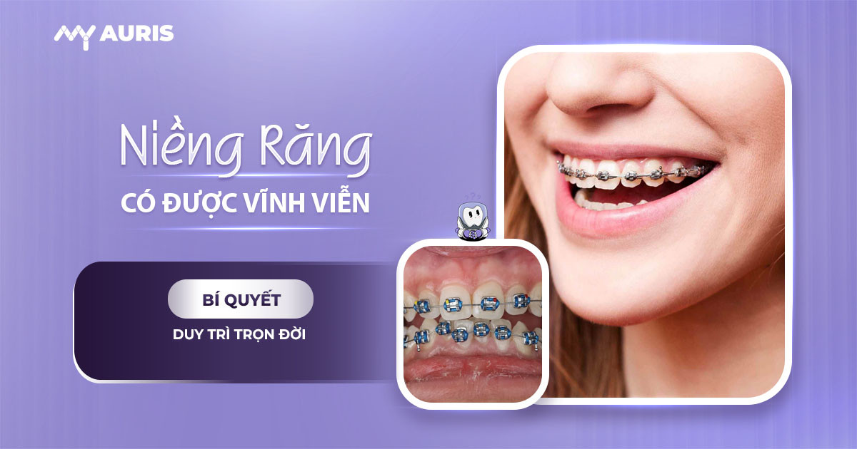 niềng răng có được vĩnh viễn không