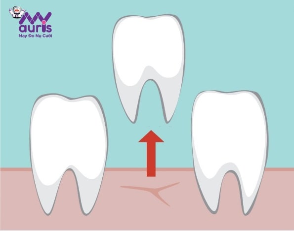 niềng răng có giảm hô hàm không