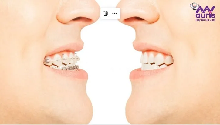 niềng răng có hiệu quả không