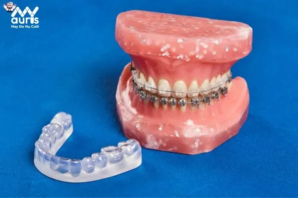 Phương pháp niềng răng cải thiện cằm lẹm hiệu quả