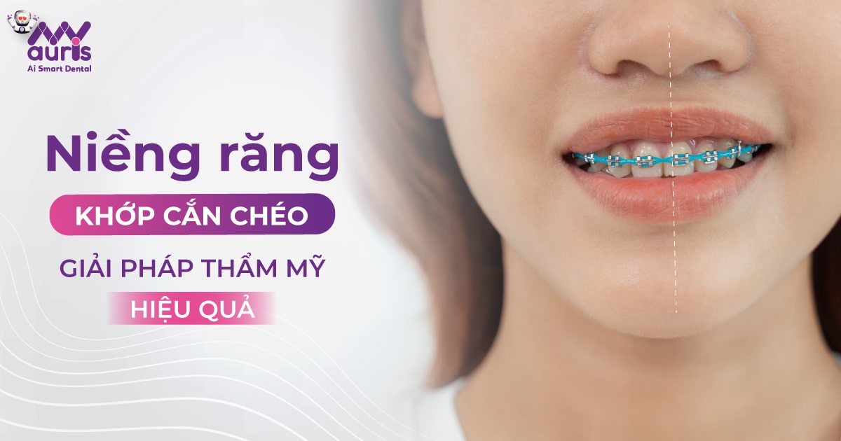 Niềng răng khớp cắn chéo