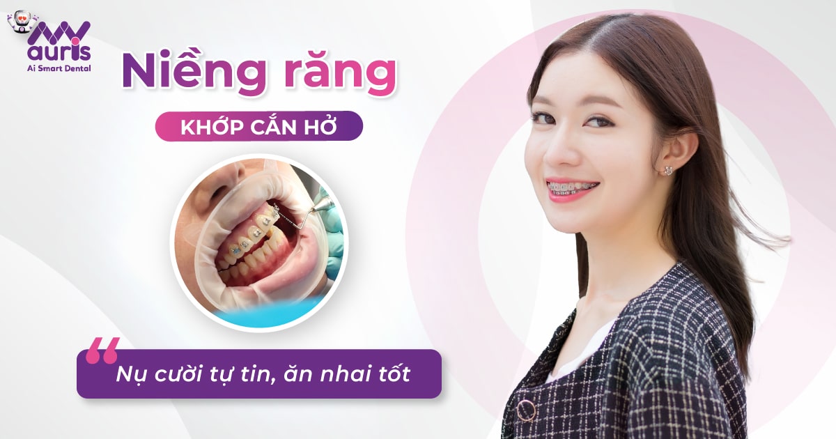 Niềng răng khớp cắn hở