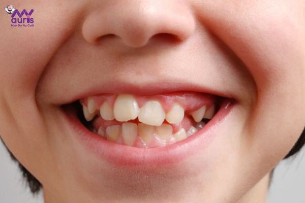 Răng lòi xỉ là gì?