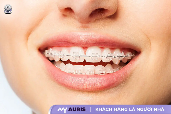 niềng răng mắc cài sứ,niềng răng mắc cài sứ giá bao nhiêu,giá niềng răng mắc cài sứ dây trong