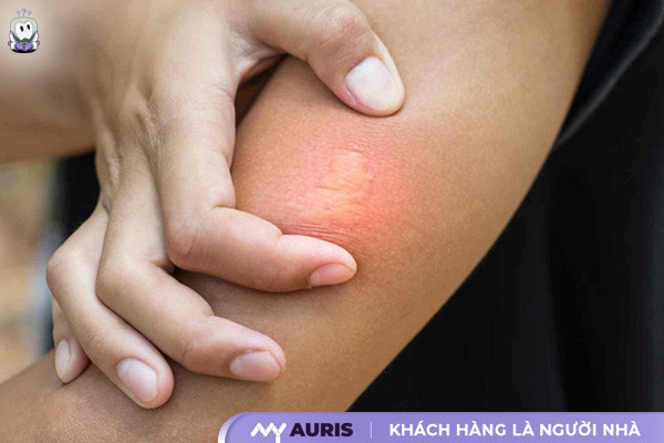 bị ong đốt phải làm gì,vết ong đốt,trị ong đốt