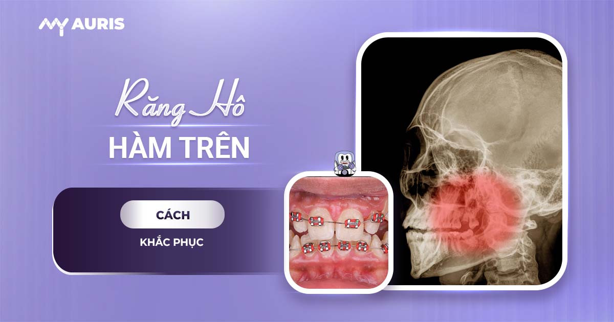 hô hàm niềng răng có cải thiện không,Răng hô hàm trên có niềng được không,Hô hàm có niềng răng được hay không,Bị hô hàm có niềng răng được không,Niềng răng hô hàm trên được không