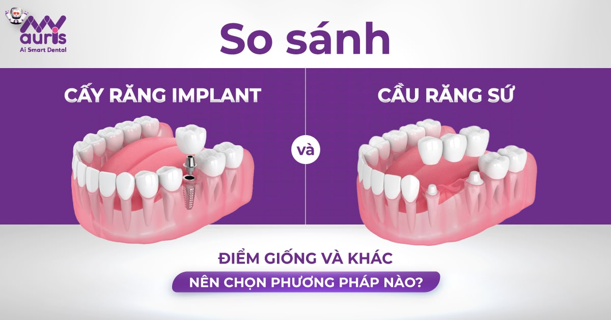 https://myauris.vn/?p=32882&preview=true So sánh cấy răng implant và cầu răng sứ