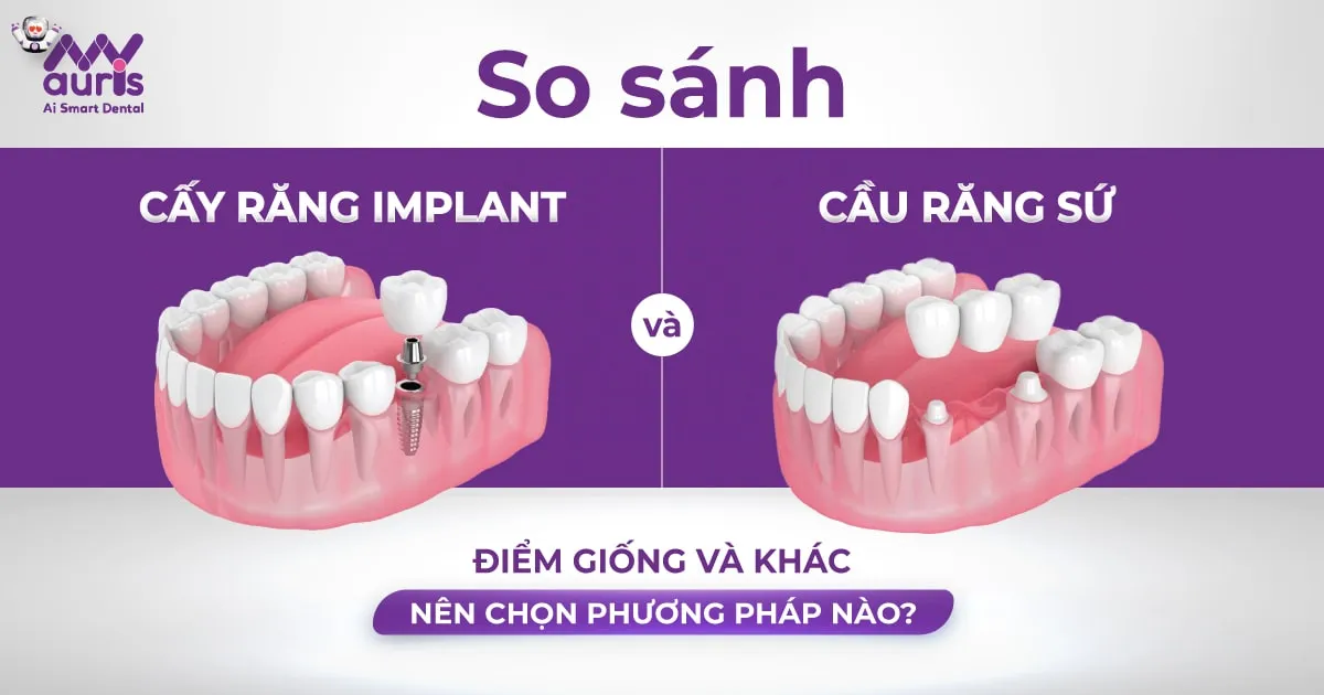 https://myauris.vn/?p=32882&preview=true So sánh cấy răng implant và cầu răng sứ