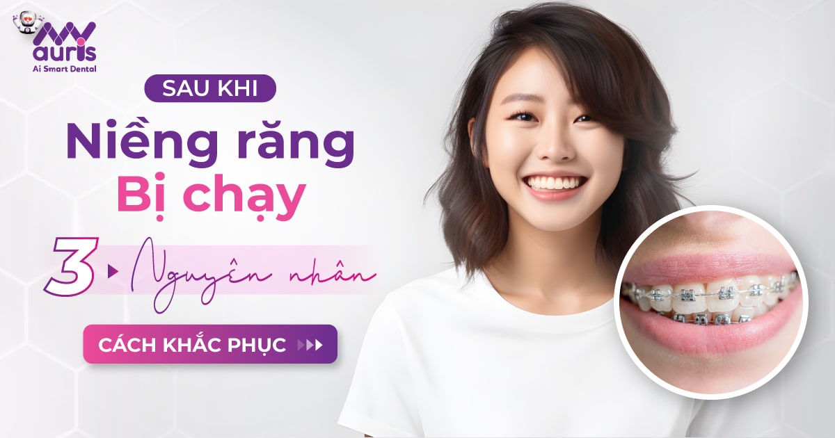 Sau khi niềng răng bị chạy