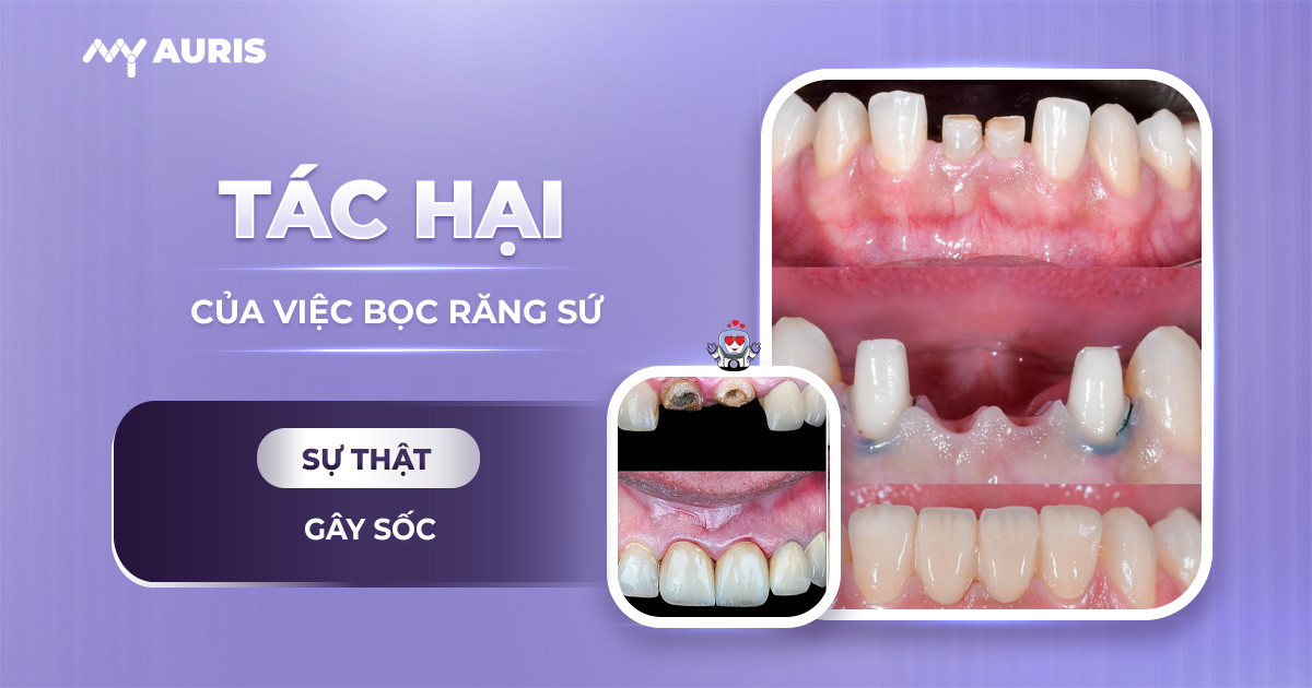 Tác hại của việc bọc răng sứ