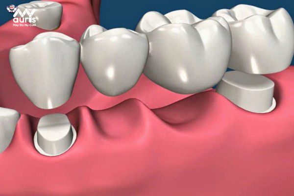 Hiểu hơn về kỹ thuật làm cầu răng sứ 