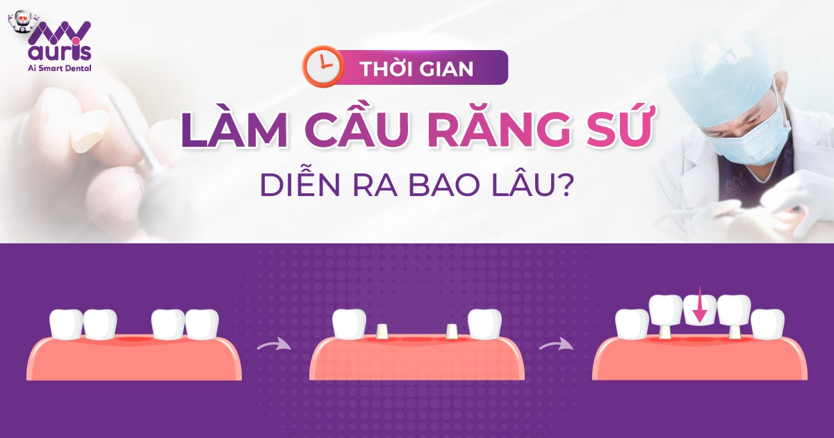 Thời gian làm cầu răng sứ diễn ra bao lâu?