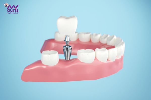 Trồng răng implant - trồng 1 răng cấm giá bao nhiêu