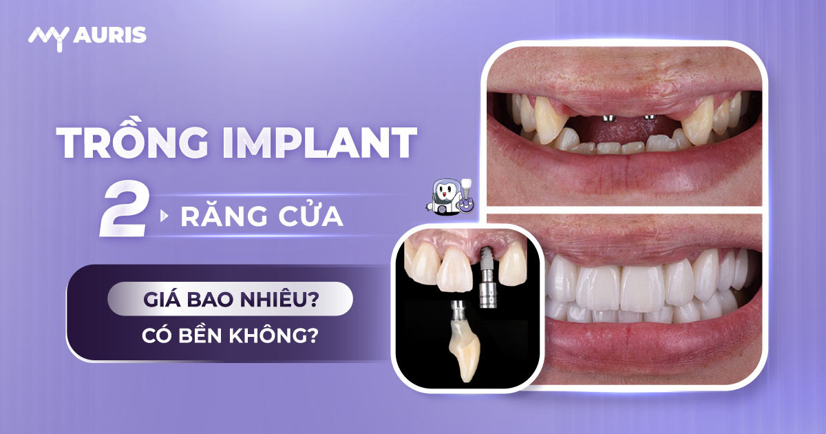 trồng 2 răng cửa giá bao nhiêu,trồng Implant 2 răng cửa,bảng giá trồng răng cửa,giá trồng răng cửa,trồng răng cửa cố định giá bao nhiêu