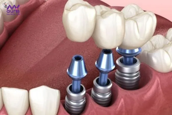 Trồng răng implant - Trồng 3 răng liên tiếp 